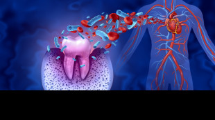 La cura delle infezioni ai denti potrebbe ridurre rischio cuore